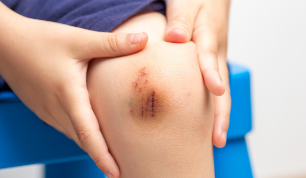 Essential First Aid for Cuts and Scrapes: A Complete Guide