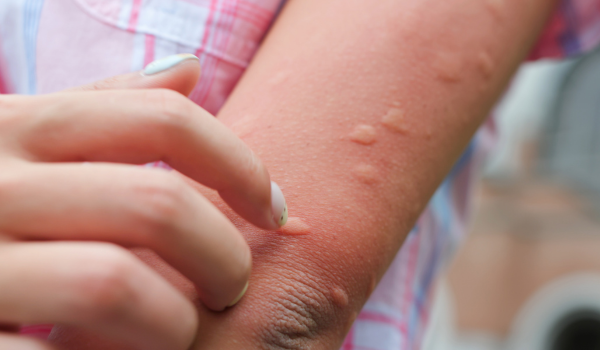 Insect bites and stings first aid: how to treat and when to act