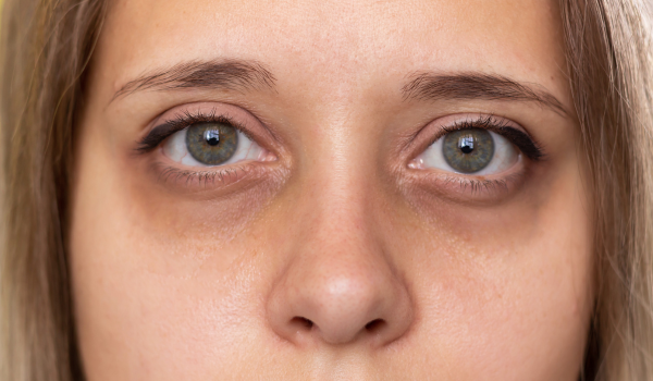 How To Treat a Black Eye With First Aid