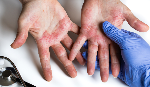 How To Treat and Prevent Blisters Effectively