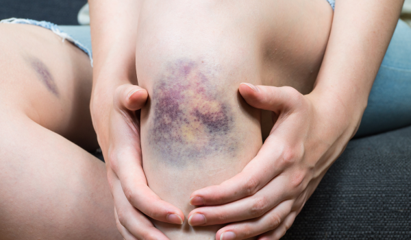 How To Care For a Bruise and Reduce Swelling