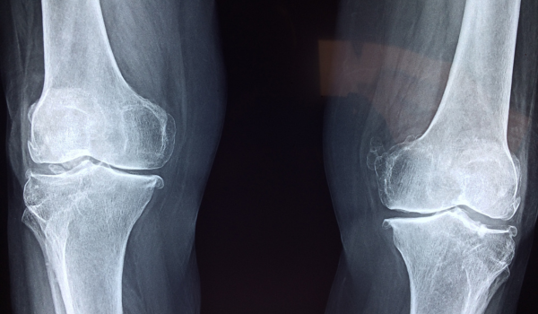 Types of Bone Marrow Cancer: Multiple Myeloma, Leukemia, and Lymphoma Explained