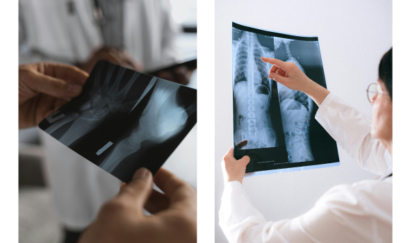 Treatment Options for Bone Marrow Cancer: From Chemotherapy to Stem Cell Transplants