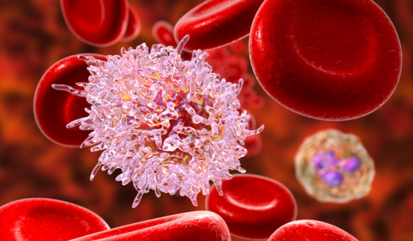 Stages of Leukemia: What They Mean for Patients