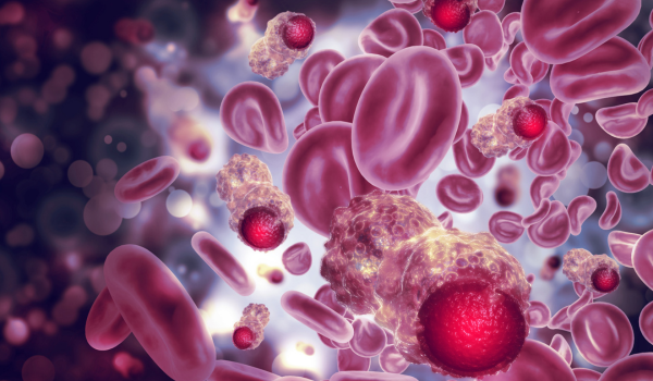 Stages of Blood Cancer: Understanding Disease Progression