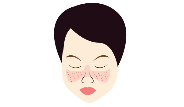 Lupus: Causes, Symptoms, Types, and How to Manage This Autoimmune Disease