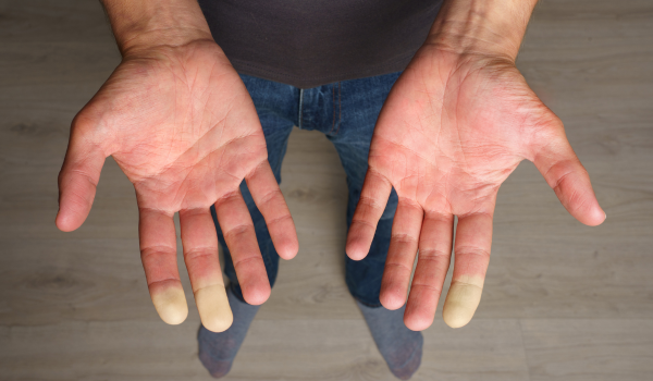 Navigating Raynaud’s Syndrome: Symptoms, Causes, and Care