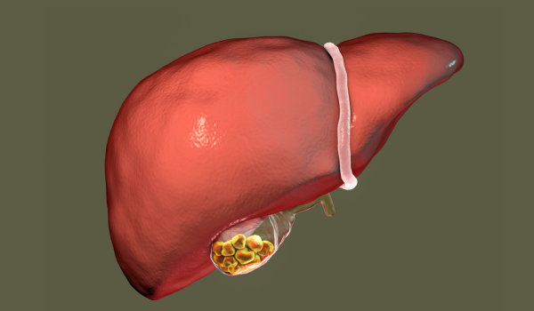What Are Gallstones?
