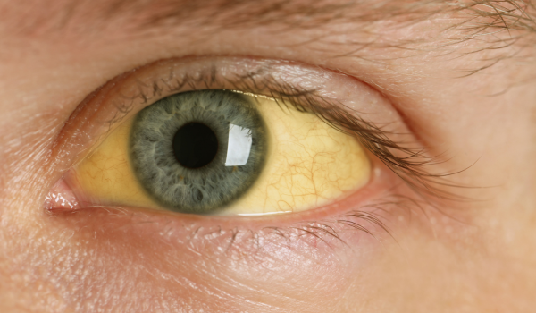 Treatment Options for Jaundice: From Medications to Lifestyle Changes
