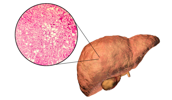 Non-Alcoholic Fatty Liver Disease: Causes, Risks, and Management