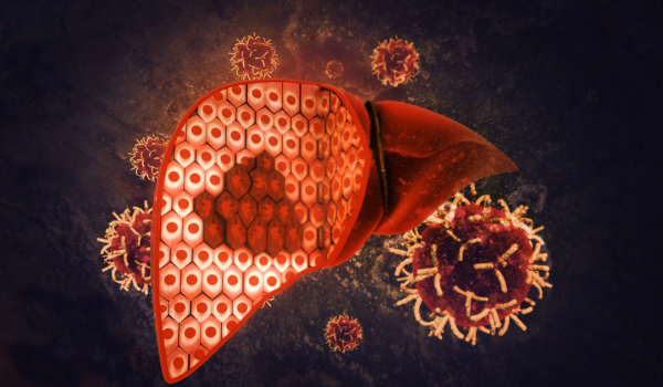 Liver Cancer: How It Develops and Treatment Options