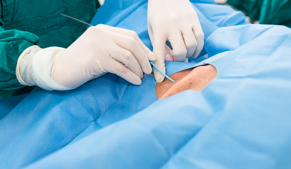 Treatment Options for May-Thurner Syndrome: Stents, Surgery, and More