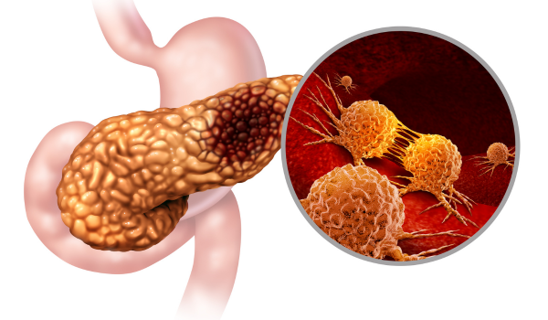 What Is Pancreatic Cancer?