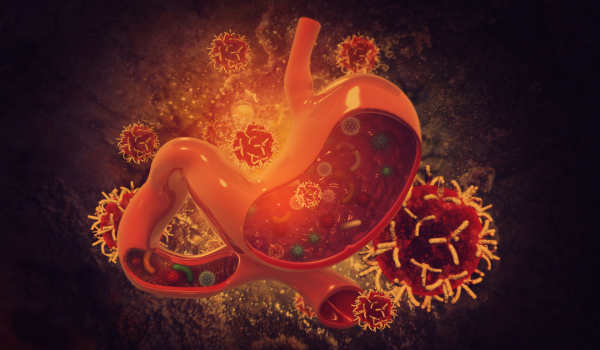 What Is Stomach Cancer?