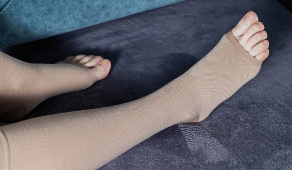 How Venous Stasis Affects the Body Over Time