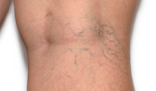 Living with DVT: Lifestyle Tips and Long-Term Management