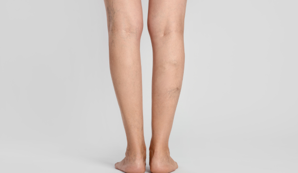 Can Deep Vein Thrombosis Be Cured? What Science Says