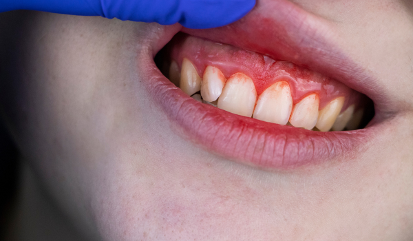 Common Causes of Gingivitis: What Leads to Gum Inflammation?