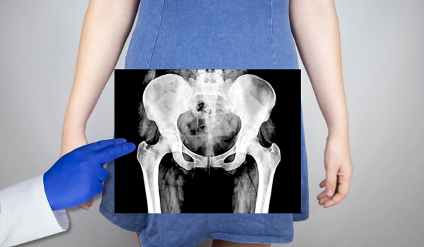May-Thurner Syndrome: Causes, Symptoms, Diagnosis, and Treatment Guide