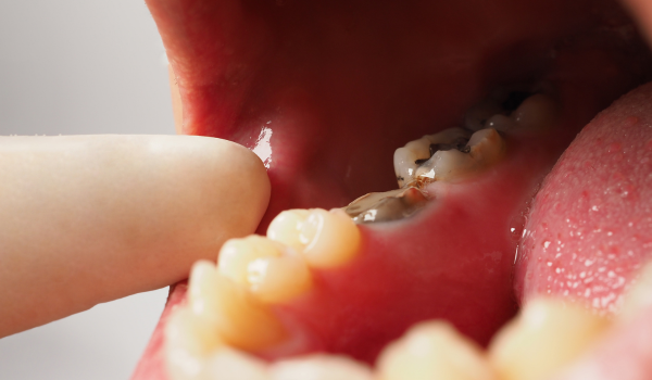 Common Oral Diseases: Cavities, Gum Disease, and More