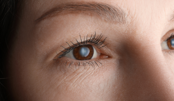 Cataracts: Causes, Symptoms, and Treatment Options