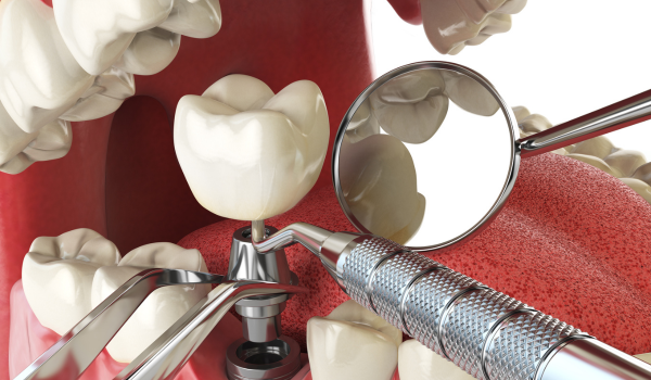 Understanding Dental Implants: Procedure, Benefits, and Risks