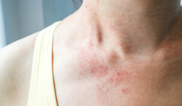 Understanding Eczema and Effective Ways to Manage It