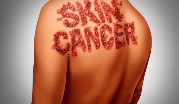 Types of Skin Cancer: Basal Cell, Squamous Cell, and Melanoma Explained