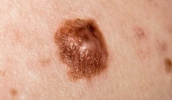 Melanoma Stages Explained: What Each Stage Means for Treatment