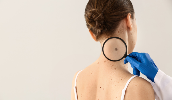 Types of Melanoma: From Superficial Spreading to Acral Lentiginous