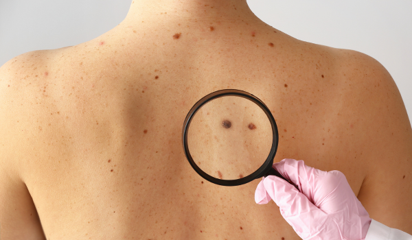 Types of Melanoma: From Superficial Spreading to Acral Lentiginous