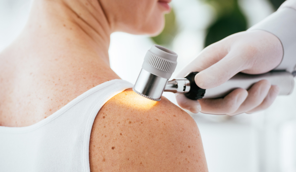 Causes and Risk Factors of Melanoma