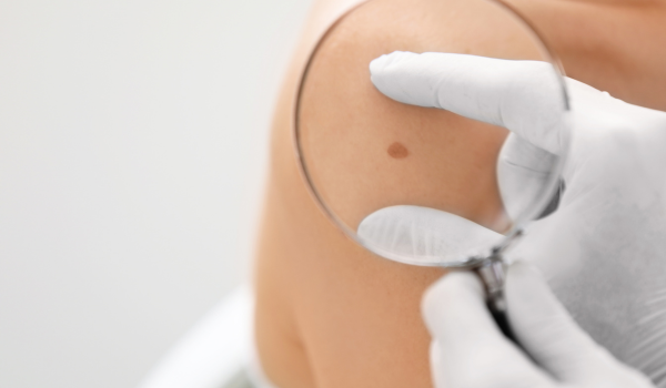 Complications of Untreated Melanoma: Why Early Action Matters