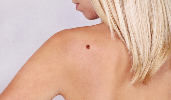 Preventing Melanoma: Smart Sun Protection and Skin Care Tips