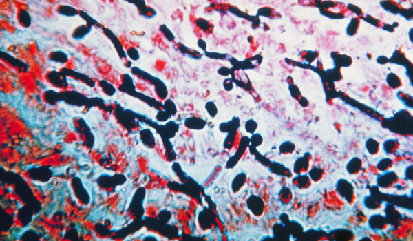 Yeast Infections: Causes, Symptoms, and How to Treat Them