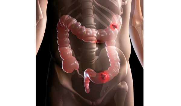 Understanding Colorectal Cancer and How to Manage It